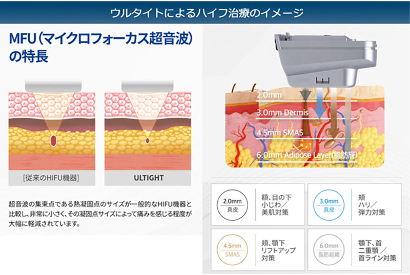 ULTIGHT（ウルタイト）によるハイフ治療のイメージ。MFU（マイクロフォーカス超音波）の特長。［従来のHIFU機器］とULTLIGHTの比較イラストと、超音波の熱凝固点サイズが小さく痛みが軽減される説明。右側にハイフ機器と皮膚断面図、2.0mm・3.0mm Dermis・4.5mm SMAS・6.0mm Adipose Layer（脂肪層）の深さ表示。2.0mm真皮：額・目の下小じわ／美肌対策、3.0mm真皮：頬ハリ／弾力対策、4.5mm SMAS：頬・顎下リフトアップ対策、6.0mm脂肪組織：顎下・首二重顎／首ライン対策。